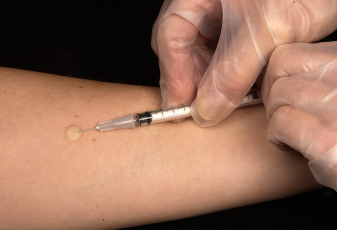 PPD Skin Test (Tuberculosis Test)